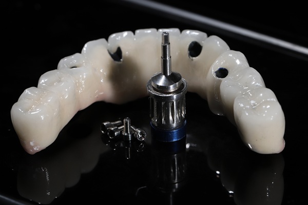 Essential Things To Know About All On Dental Implants